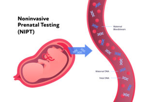 NIPT